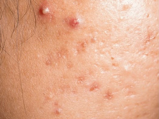 Acne Control