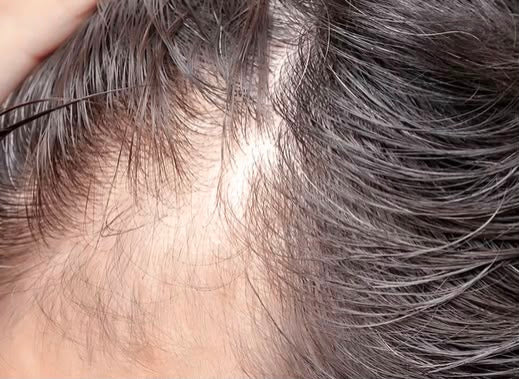 Hair Fall